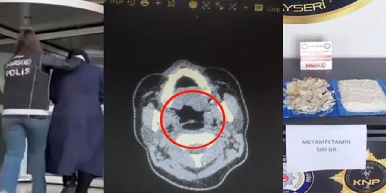 doktorlar bile inanamadi midesinden tam 500 gram metamfetamin cikti cBXdJw4h.jpg